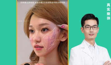 顾六六医生案例【01】AI复塑馒化脸+骨韧双悬祛馒提升 对比分享