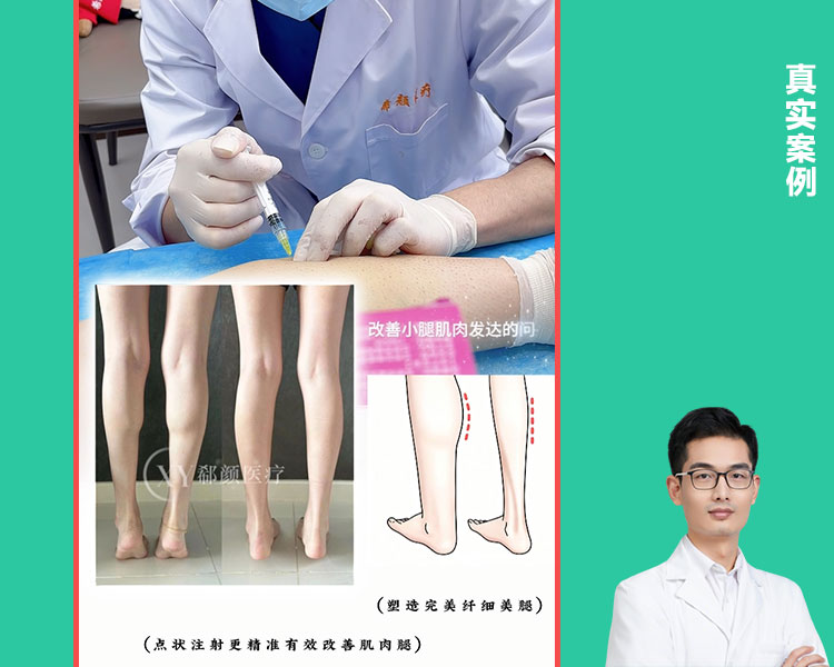 希颜医疗顾六六瘦腿针案例